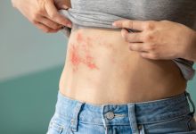 Photo of 78% dos doentes crónicos com mais de 50 anos temem o impacto da Zona